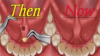 Stone Removal from tonseil Treatment ASMR Animation asmr animation tonsils gaming health game [upl. by Inavoj]