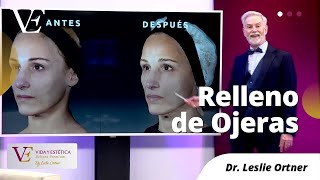 RELLENO DE OJERAS CON ÁCIDO HIALURÓNICO  DR LESLIE ORTNER [upl. by Suivat846]