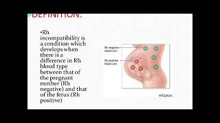 Rh incompatibility in pregnancy  Rhesus Status and AntiD in Pregnancy [upl. by Andy483]