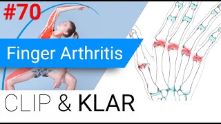 Finger Arthritis erklärt  Rheumatoide Arthritis Psoriasis und Co [upl. by Aciretal]