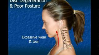 Cervical Disc Degeneration [upl. by Babbette]