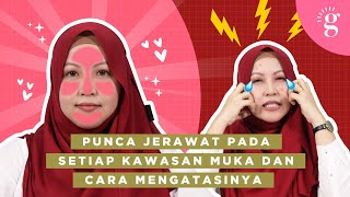 Punca Jerawat Pada Setiap Kawasan Muka Dan Cara Menghilangkannya [upl. by Ttehr223]