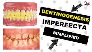 Dentinogenesis Imperfecta Simplified [upl. by Scandura]