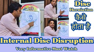 Internal Disc Disruption  Mechanism Behind Disc Herniation  Dr Rajesh Sharma PT [upl. by Bigg]