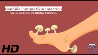 Candida Fungus Skin Infection Explained What You Need to Know [upl. by Esidnak]