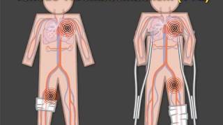 Preventing Thromboembolism after Arthroscopy and Casting [upl. by Hanahs868]