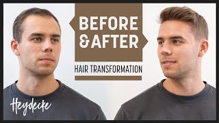 Hair Loss At 20  The Solution For Instant Full Hair [upl. by Madda394]