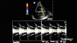 The “seagull cry” An initial sign in a child with intracranial carotid stenosis [upl. by Adin]