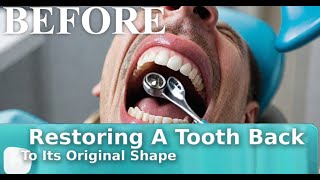 Restoring A Tooth Back To Its Original Shape  Dental Health Hub [upl. by Lindsay]