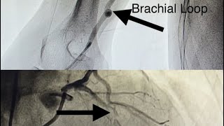 Brachial Loop in Acute Extensive Anterior MI and Thrombus Grade V How To Deal With [upl. by Magree]