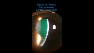 Intermediate Uveitis  Vitritis amp Mutton Fat KPs [upl. by Arimlede759]