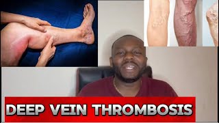 Causes And Effects Of Deep Veins Thrombosis dvt [upl. by Kauslick438]