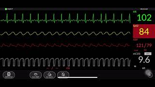 Simulated Patient Monitor [upl. by Ynffit]