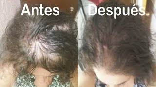 Caida de Cabello en Mujeres  Alopecia Femenina [upl. by Llerrehs]