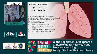 Pneumonia in immunocompromised pediatric patients [upl. by Zipah]