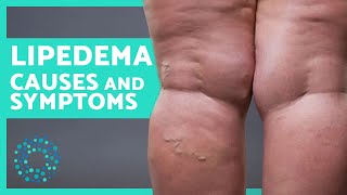 SIGNS You Suffer from LIPEDEMA 🦵🏼 Possible Causes and Treatments [upl. by Lagasse]