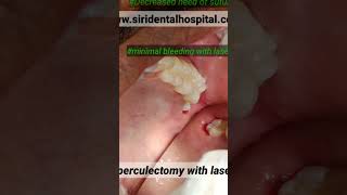 Pericoronitis treatment at siri dental with laser no blood no sutures and faster healing also [upl. by Laamak903]