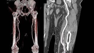 CT of Abdominal Aorta Aneurysms Dissections and Repair Part 1 [upl. by Aitan331]