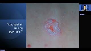 Webinar Psoriasis okt24 [upl. by Eclud]