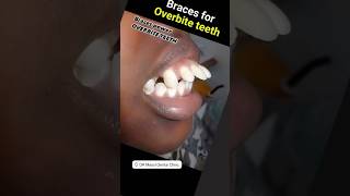 Braces Power for severe Overbite [upl. by Chloette3]