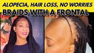 Beautiful Frontal Braids for Alopecia Hair Loss amp Thin Hair [upl. by Mufi]