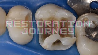 RESTORATIVE JOURNEY amalgam to composite [upl. by Coltun]