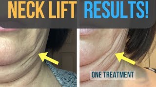 Results From My Fibroblast Plasma Neck Lift [upl. by Alimaj752]