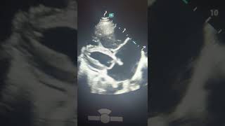 Sinus venosus ASD echocardiography science echocardiographer [upl. by Ogires]