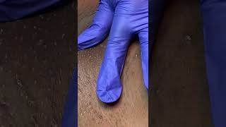 EXTRACTIONS  INGROWN HAIR REMOVAL [upl. by Alrats]