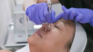 Microdermabrasion Facial [upl. by Elliven]