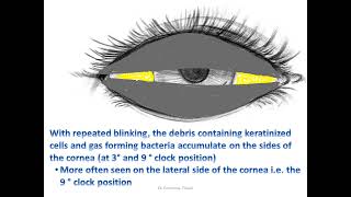 How Do ‘Bitot’s Spots’ Form [upl. by Arraes]