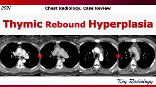 Thymic rebound hyperplasia [upl. by Awra]