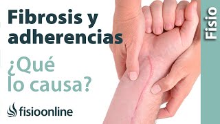 Fibrosis y adherencias  ¿Qué es y cuáles son sus causas [upl. by Ellehctim]