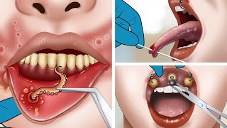 ASMR Mouth ulcer treatment amp removal tongue piercing [upl. by Arelc994]