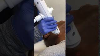 Nurse Revay Treats Laser Hair Removal PFB on Skin of Color Patient [upl. by Honig]