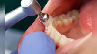 Detartraje supragingival y subgingival [upl. by Llertrac881]