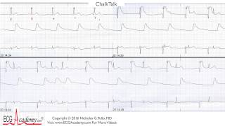 ECG Interpretation Tutorial  ChalkTalk 248 Advanced Level [upl. by Bernard789]