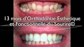 Sourire gingival adulte  correction en 13 mois par aligneurs® en OEFS© [upl. by Elokkin]