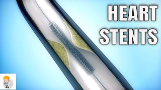 Drugeluting stents DES Vs Bare metal stents BMS [upl. by Leo]