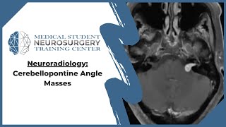 Neuroradiology Cerebellopontine Angle Masses [upl. by Uhn]