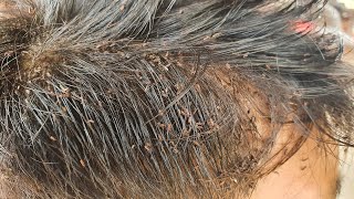 Chill video to watch head lice removal 42 [upl. by Ssenav]