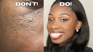 DOS AND DONTS TO APPLYING MAKEUP ON PITTED ACNE SCARSICEPICK SCARSBOXCAR SCARS [upl. by Tireb]