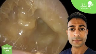 1173  Bursting Eardrum after Discharge amp Ear Wax Removal [upl. by Huebner]