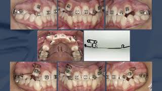 A simple approach to correct ectopic eruption of maxillary canines [upl. by Arakihc]