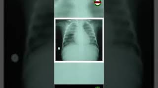 What Is Pulmonary Edema [upl. by Repsaj]