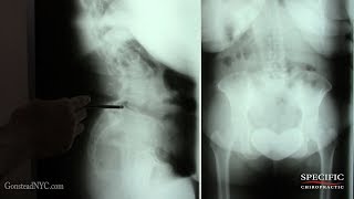 Double Spondylolisthesis without surgery by Dr Suh Gonstead Chiropractic [upl. by Salahcin]