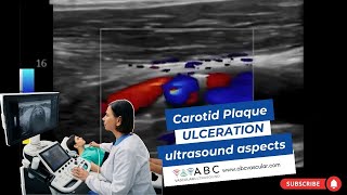 CAROTID PLAQUE ULCERATION ULTRASOUND ASPECTS [upl. by Eiznil]