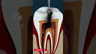 Root Canal Treatment [upl. by Koblick]