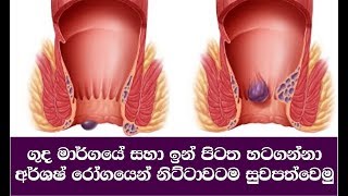 අර්ශෂ් රෝගයෙන් නිට්ටාවටම සුවපත්වෙමු  Hemorrhoids Piles Symptoms causes and treatments [upl. by Bambi271]