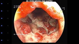 Chronic Ulcerative Colitis  Colonoscopy [upl. by Nawek]